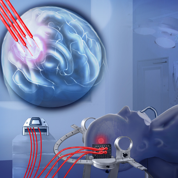 Medical illustration of a glioblastoma treatment procedure showing fluorescence-guided surgery and photodynamic therapy.