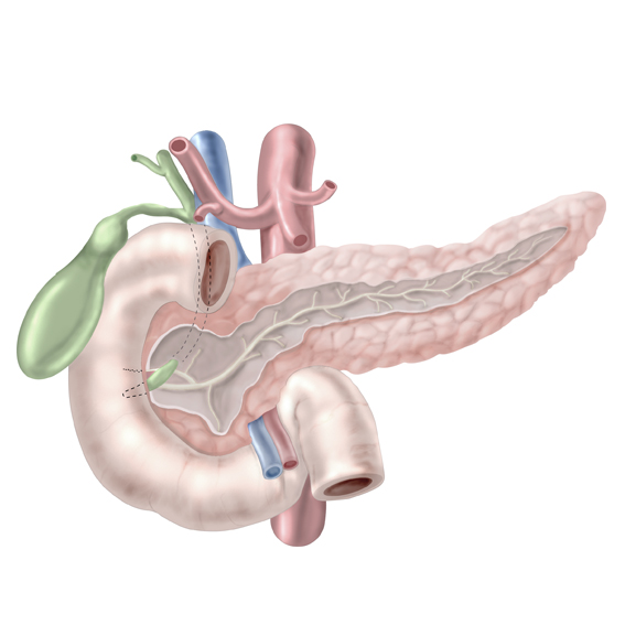 Anatomical illustration of the pancreas, duodenum, gallbladder, bile ducts, pancreatic duct, and surrounding blood vessels.